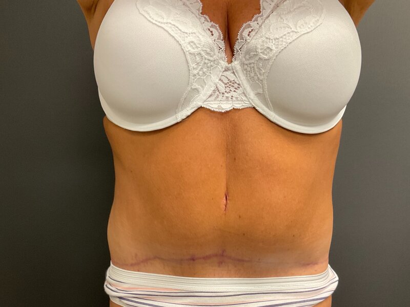 Tummy Tuck Before & After Image