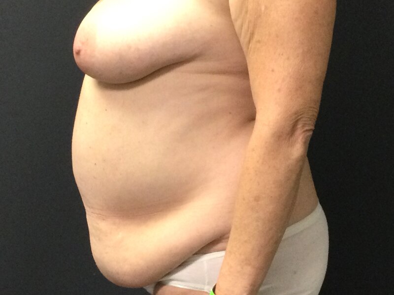 Tummy Tuck Before & After Image