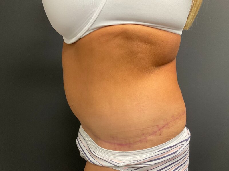 Tummy Tuck Before & After Image