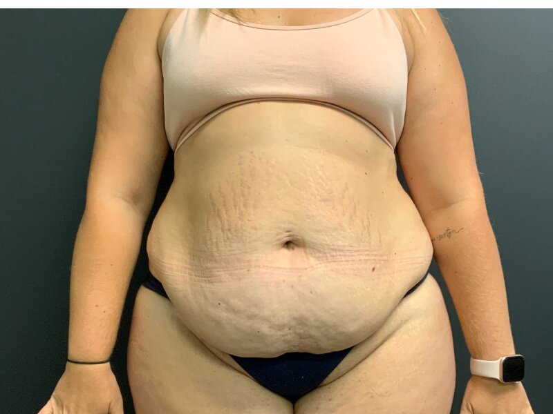 Tummy Tuck Before & After Image