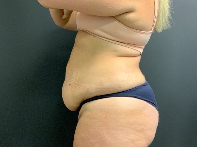 Tummy Tuck Before & After Image