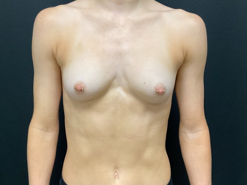 Breast Augmentation Before & After Image