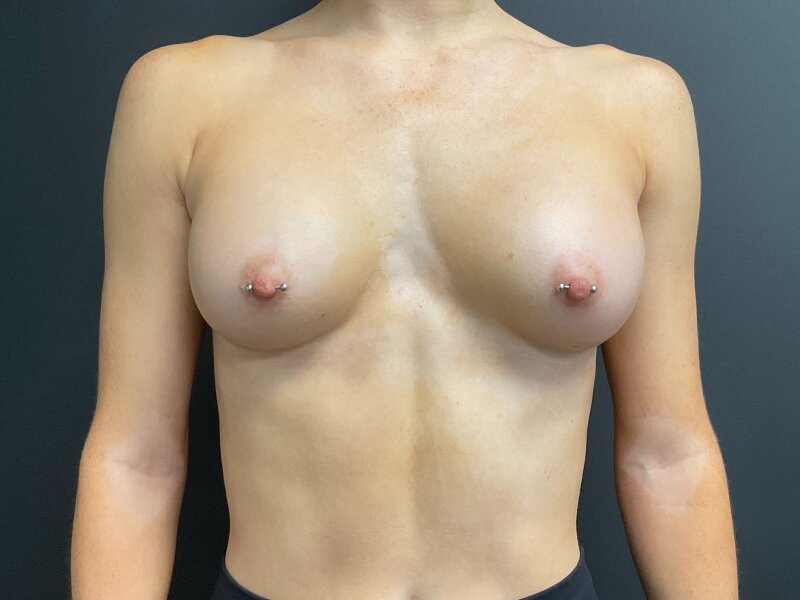 Breast Augmentation Before & After Image