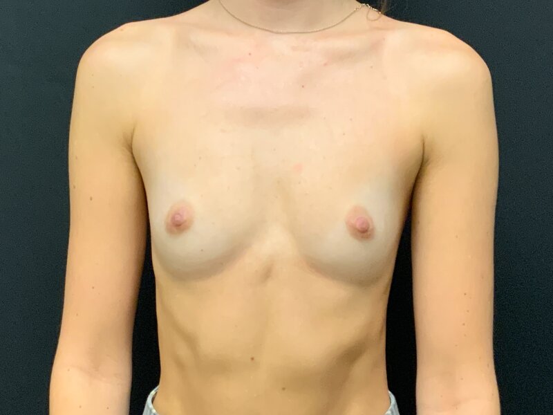 Breast Augmentation Before & After Image