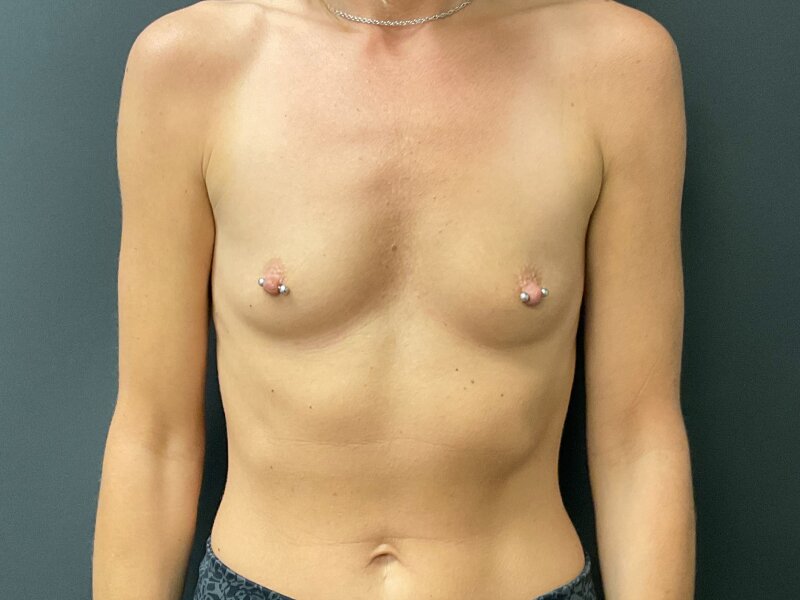 Breast Augmentation Before & After Image